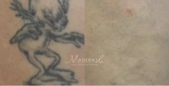 Laser-tatoo-removal-before-and-after-1