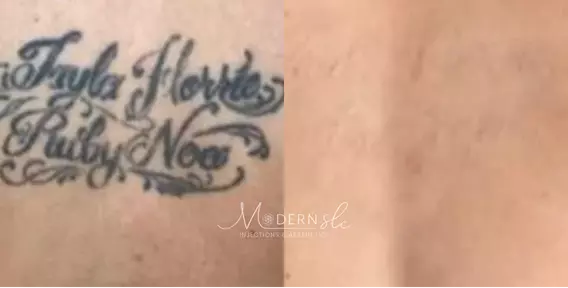 Laser-tatoo-removal-before-and-after-3