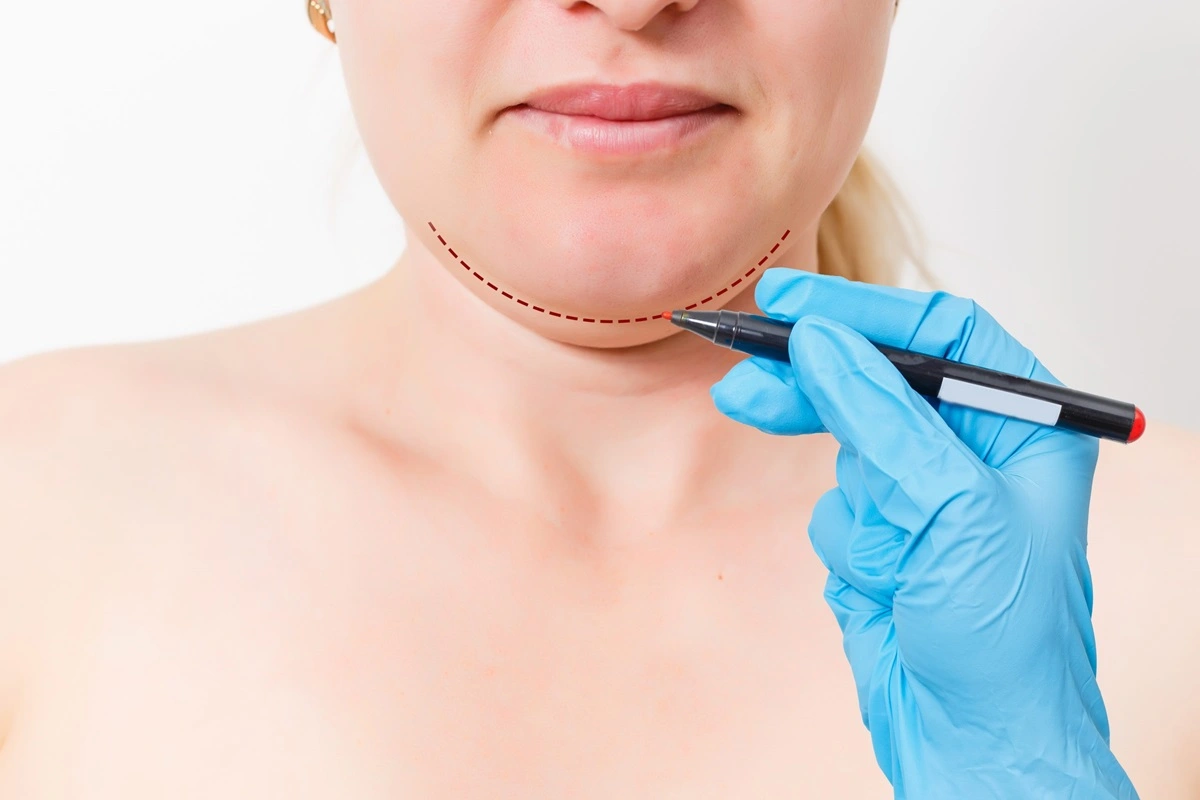 Everything-You-Need-to-Know-About-Kybella-Aftercare-modern-slc-injections-aesthetics-in-salt-lake-city-utah