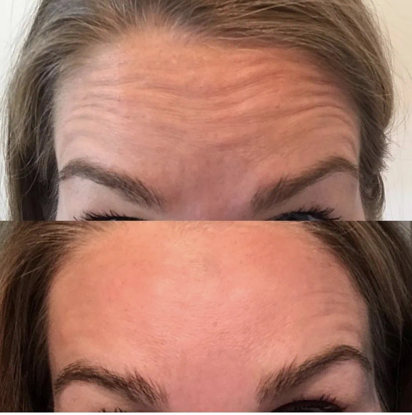 Botox-Dysport-modern-slc-injections-aesthetics-in-salt-lake-city-utah