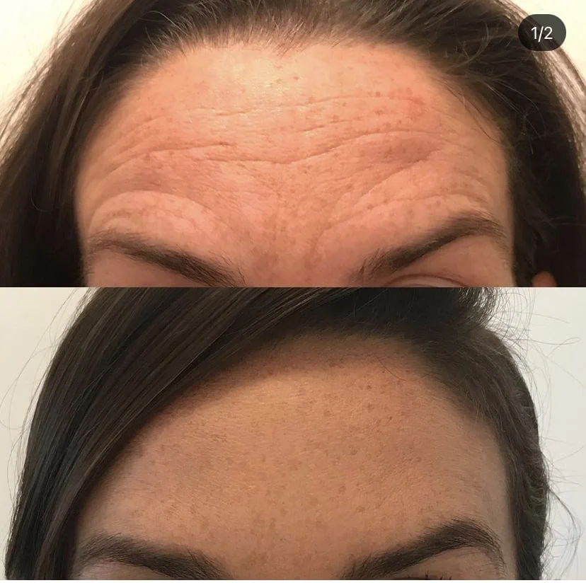 Dysport-Salt-modern-slc-injections-aesthetics-in-salt-lake-city-utah