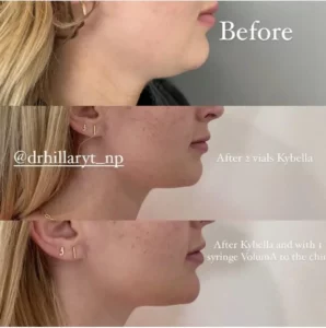 Kybella-Before-After-Modern-SLC-Injections-Aesthetics-in-Salt-Lake-City-Utah