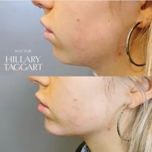 Kybella-Before-After-Two-modern-slc-injections-aesthetics-in-salt-lake-city-utah