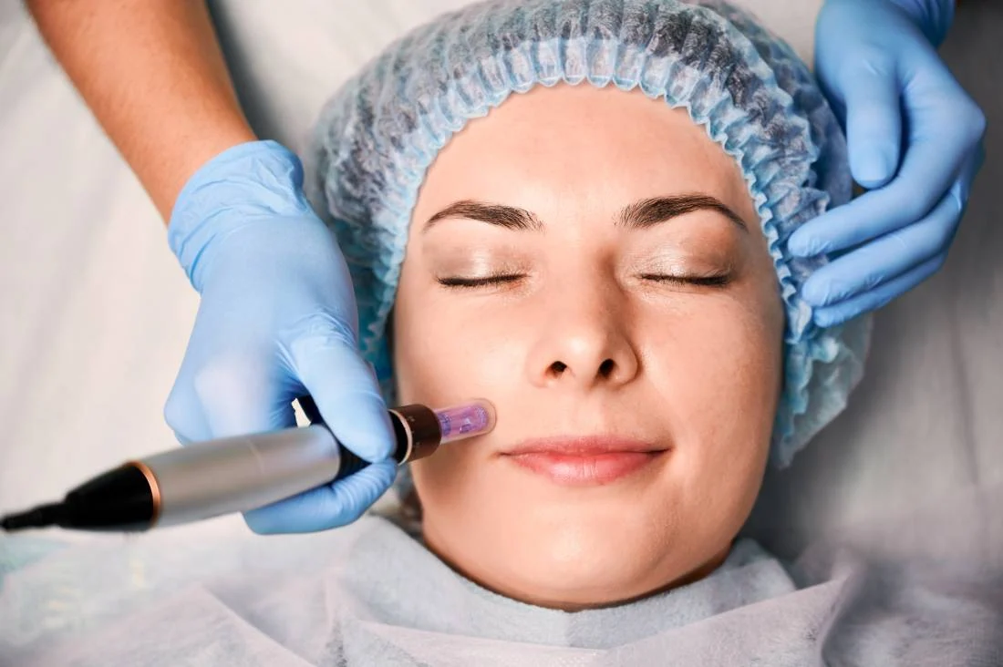 Microneedling-Modern-Medical-Aesthetics-Holladay-Utah