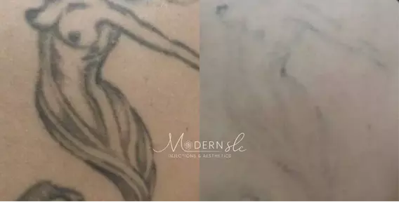 Laser-tatoo-removal-before-and-after-2