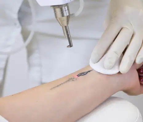 Laser Tattoo Removal in Salt Lake City, UT | Modern SLC